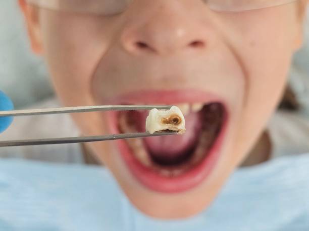 Best Emergency Dental Extractions in Ranchester, WY